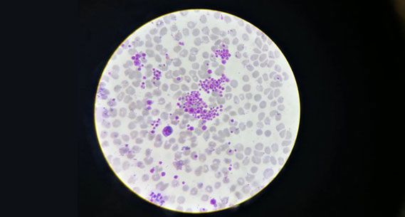 Microscope image: platelets clumping in an EDTA sample