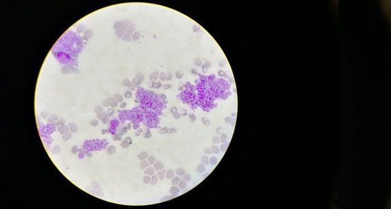 Microscope image: platelet clumping in EDTA